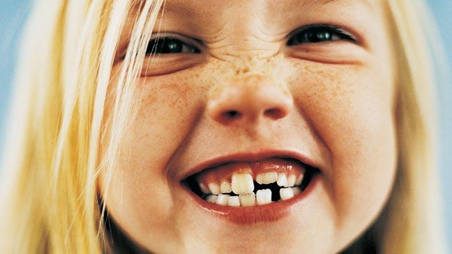 Children Teeth Information, Teething Blog, Kid Orthodontics, third molars question, clear aligner question, clear aligners question, clear aligner questions