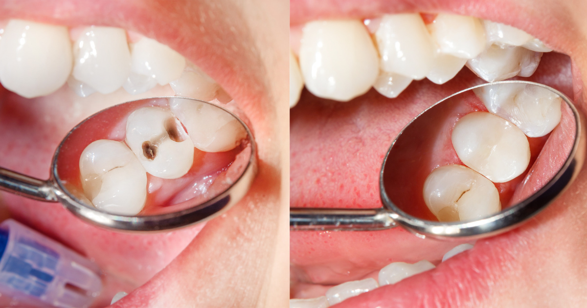 Composite filling chat, tooth bonding chatting, composite fillings blog