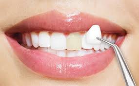 Dental Veneers Information, Cosmetic Dental Veneers Chat, Local Cosmetic Dental Veneer Blog, Dental Veneers Blogging