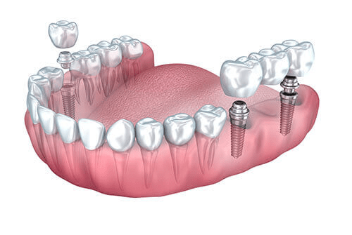 Best dental implants placement information