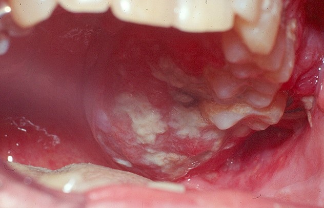 Oral Cancer Chat, Mouth Cancer Treatment Blog Online and mouth cancer blogging online.