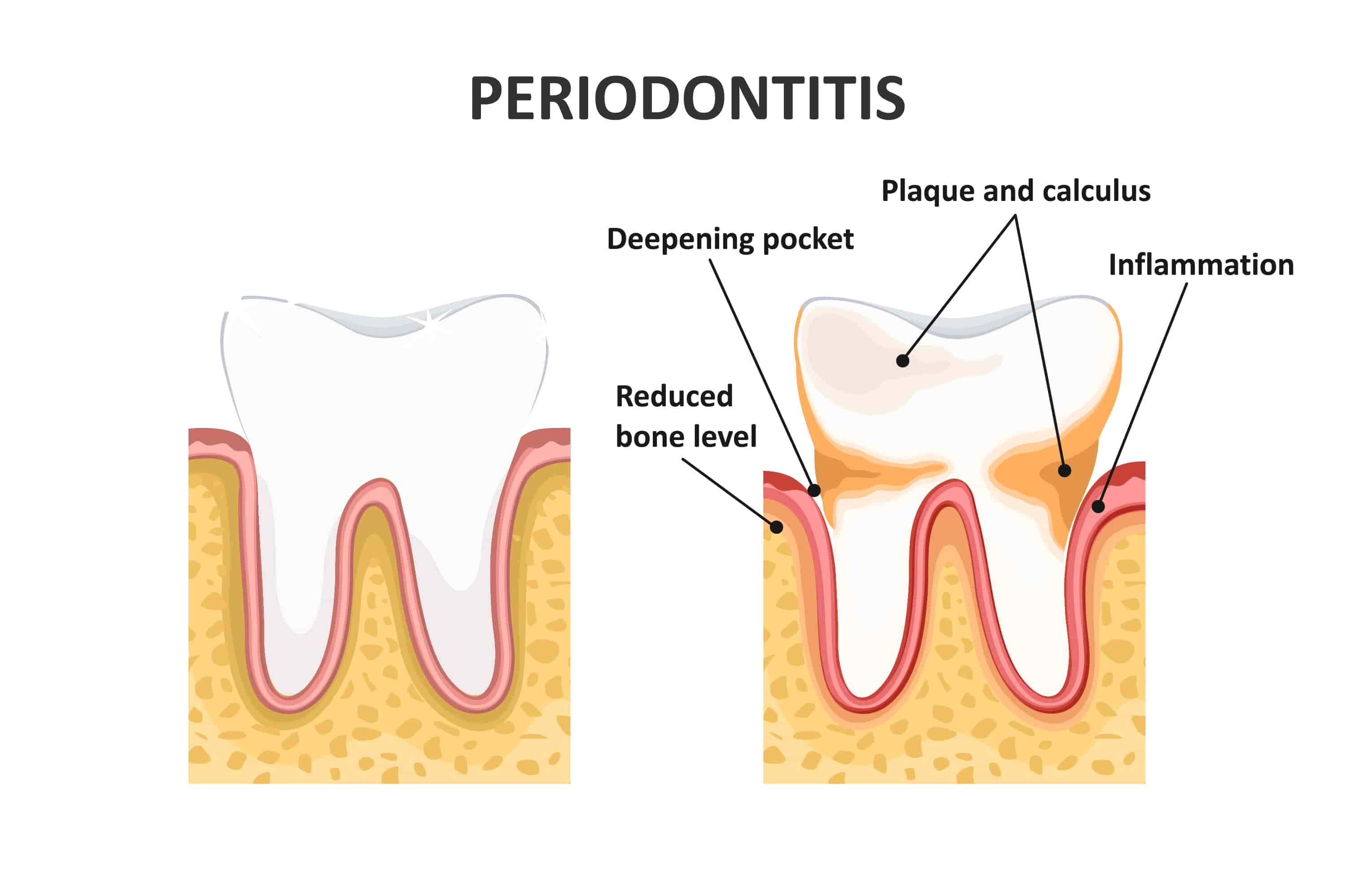 Periodontitis Chatting, Perio Treatment Chat, Local Periodontist Blog, Online Periodontitis Discussion: