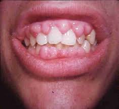Swollen painful gums question, Tooth brushing and good oral hygiene chat