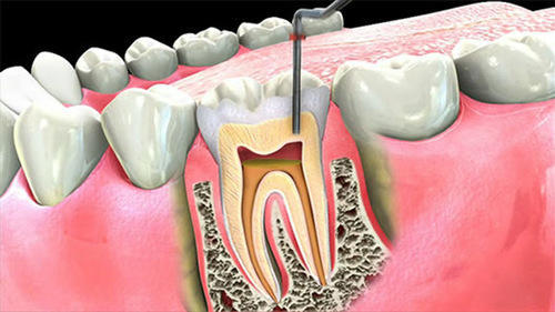 root canal cost and root canals treatment price question online