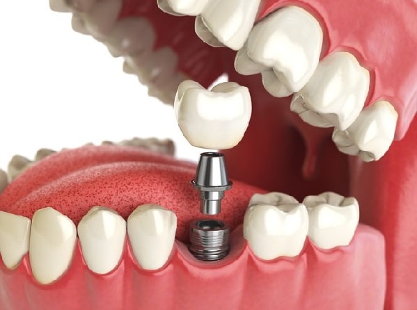 local dental implant cost and dental implants question online