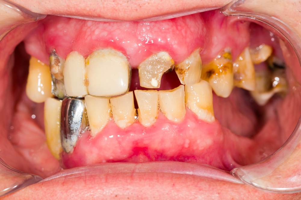 bad tooth blog, bad teeth replacement