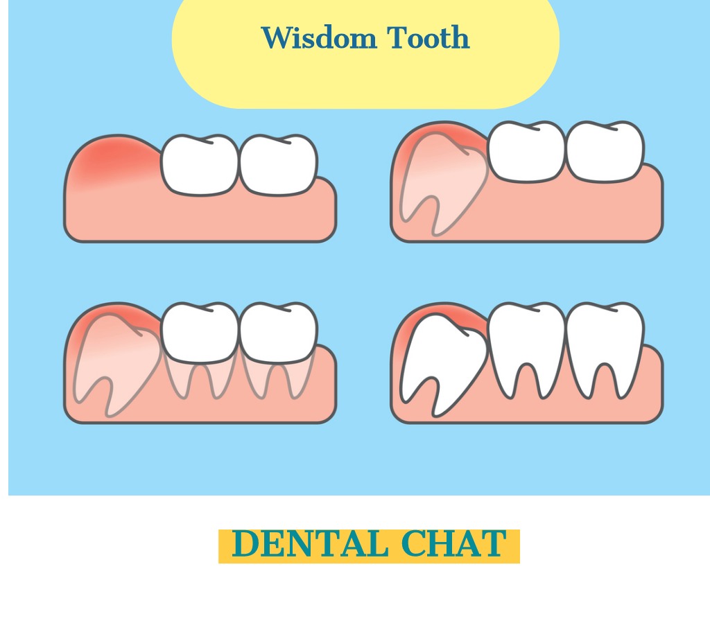 Wisdom Teeth Question Blog